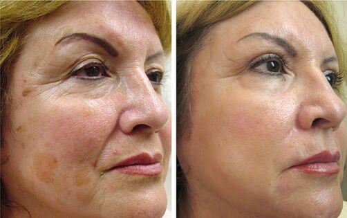 Anna from Wroclaw got a noticeable effect in smoothing wrinkles and tightening the face contour after using Canabilab
